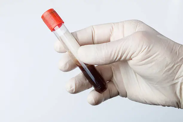 Imagem ilustrativa de Pcmso exame de sangue